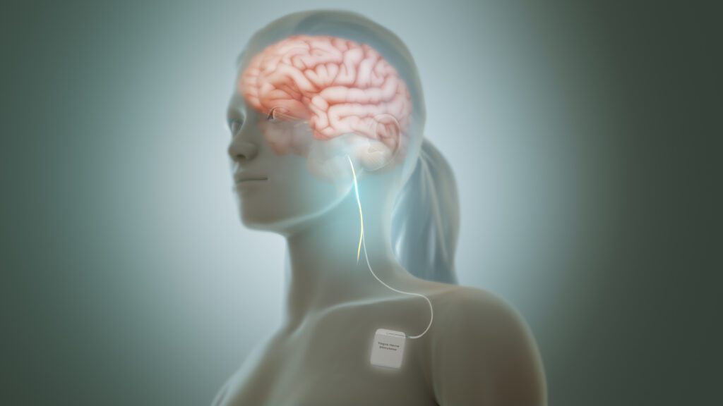A digital illustration of a woman showing a transparent view of her brain connected by wires to a medical device...